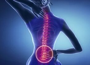 Manifestări ale osteochondrozei lombare